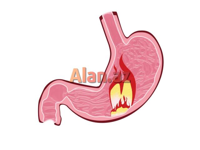 Qastritin təbii müalicəsi